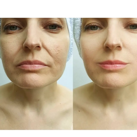 Skin Booster, Biorevitalizant. Help Produce Collagen,3 ampoulles/2.2ml each, - Picture 7 of 7